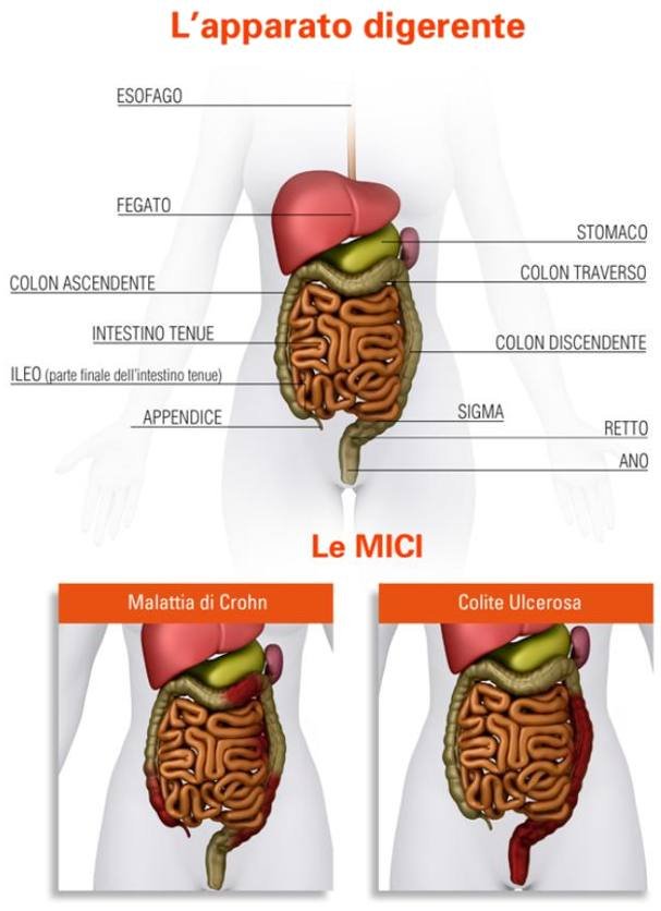 MICI1